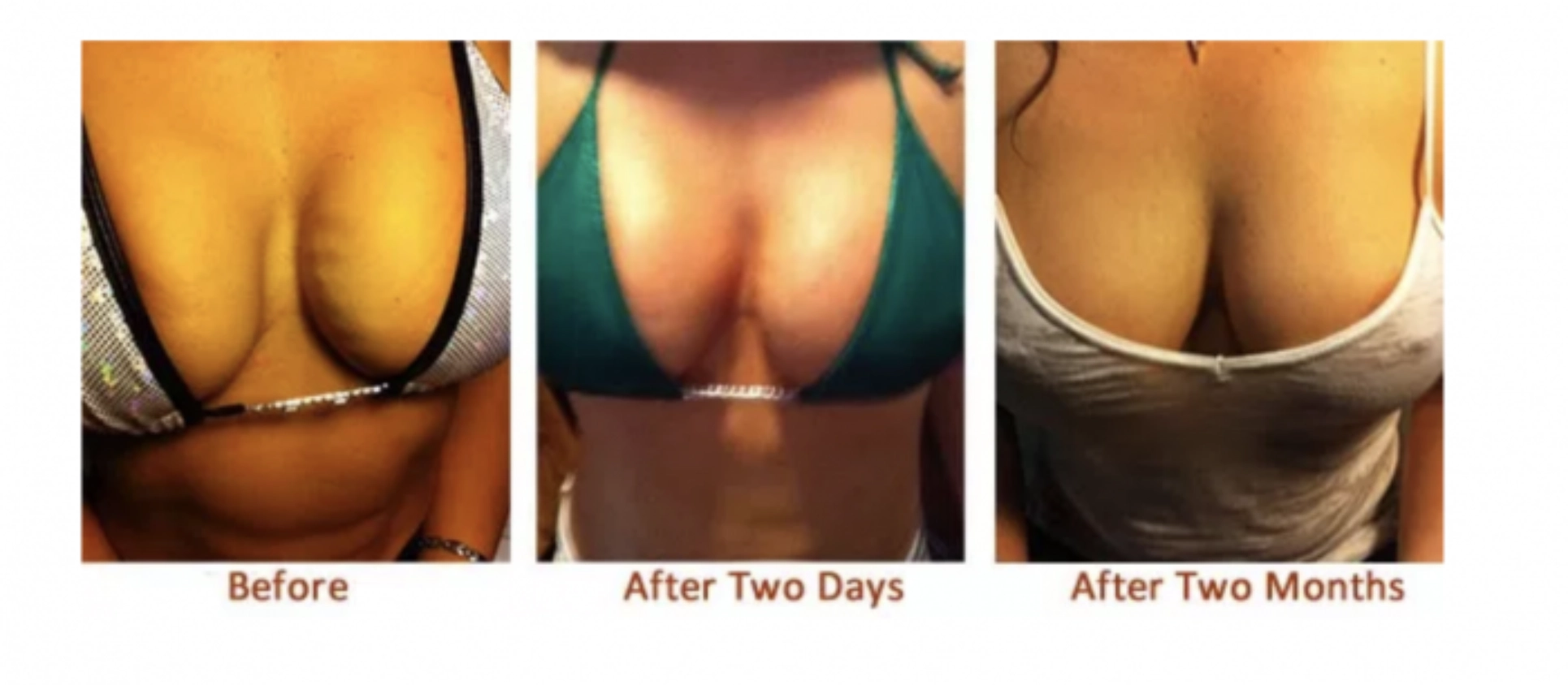 Vampire Breastlift Park City