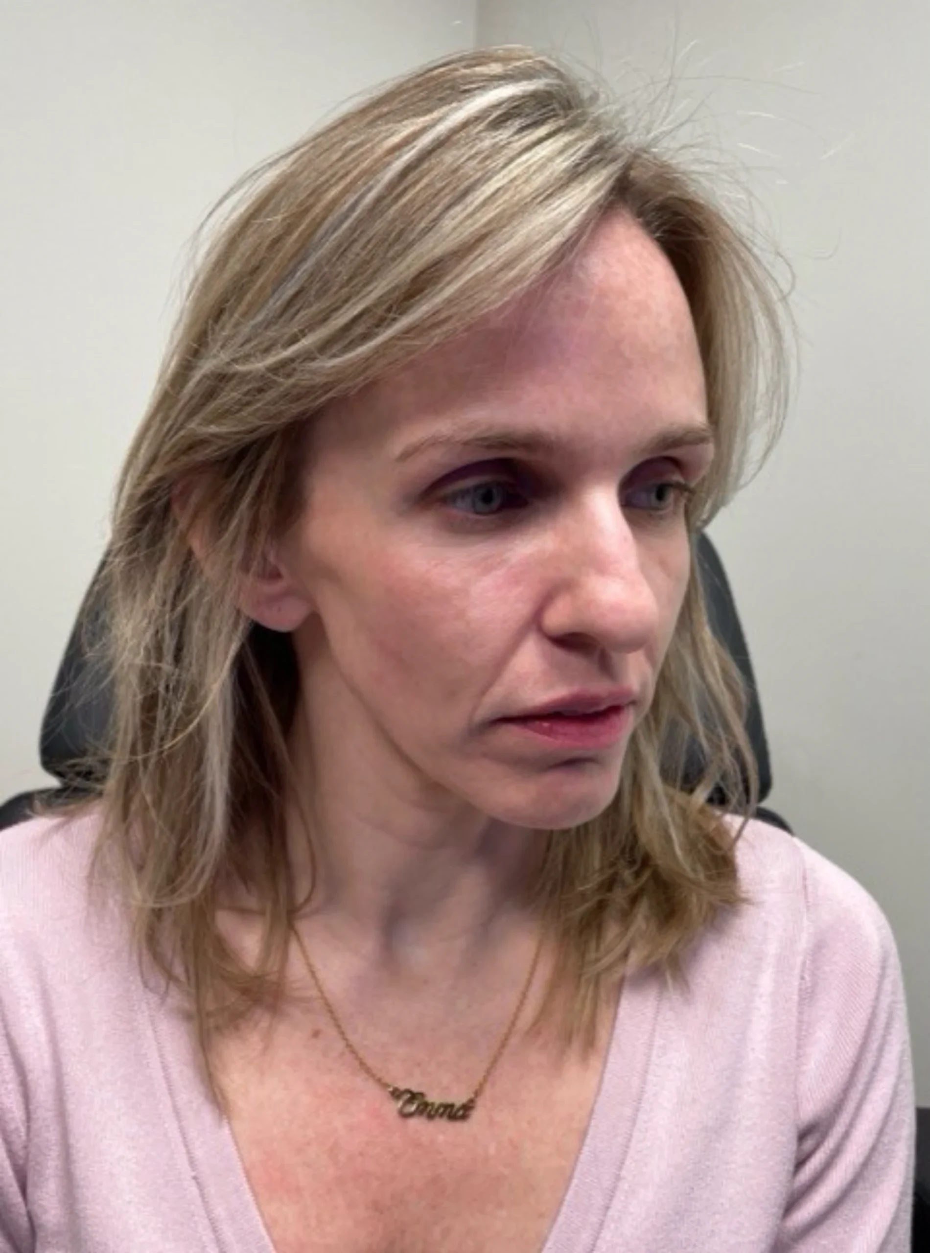 Cheek Fillers Park City