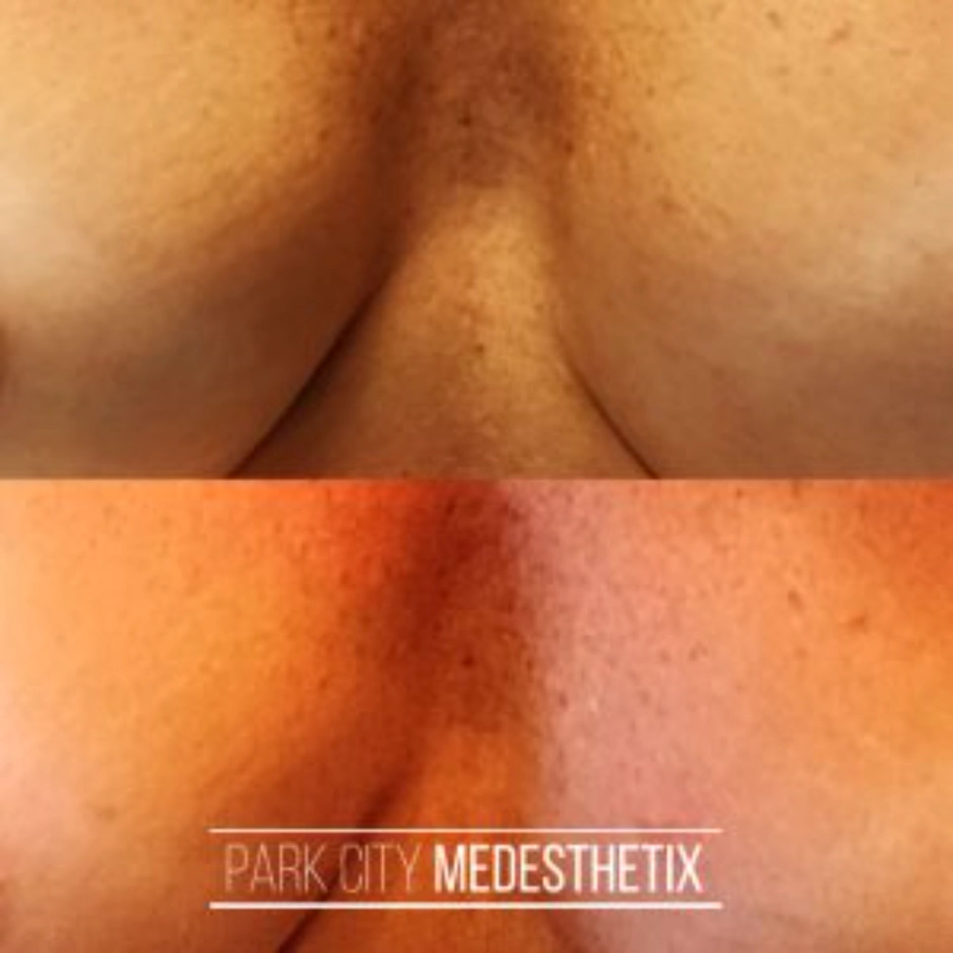 Vampire Breastlift Park City