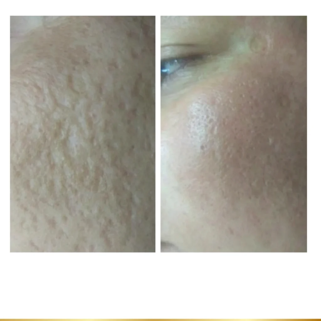 Before and after mesoneedling acne scar treatment on the cheek.