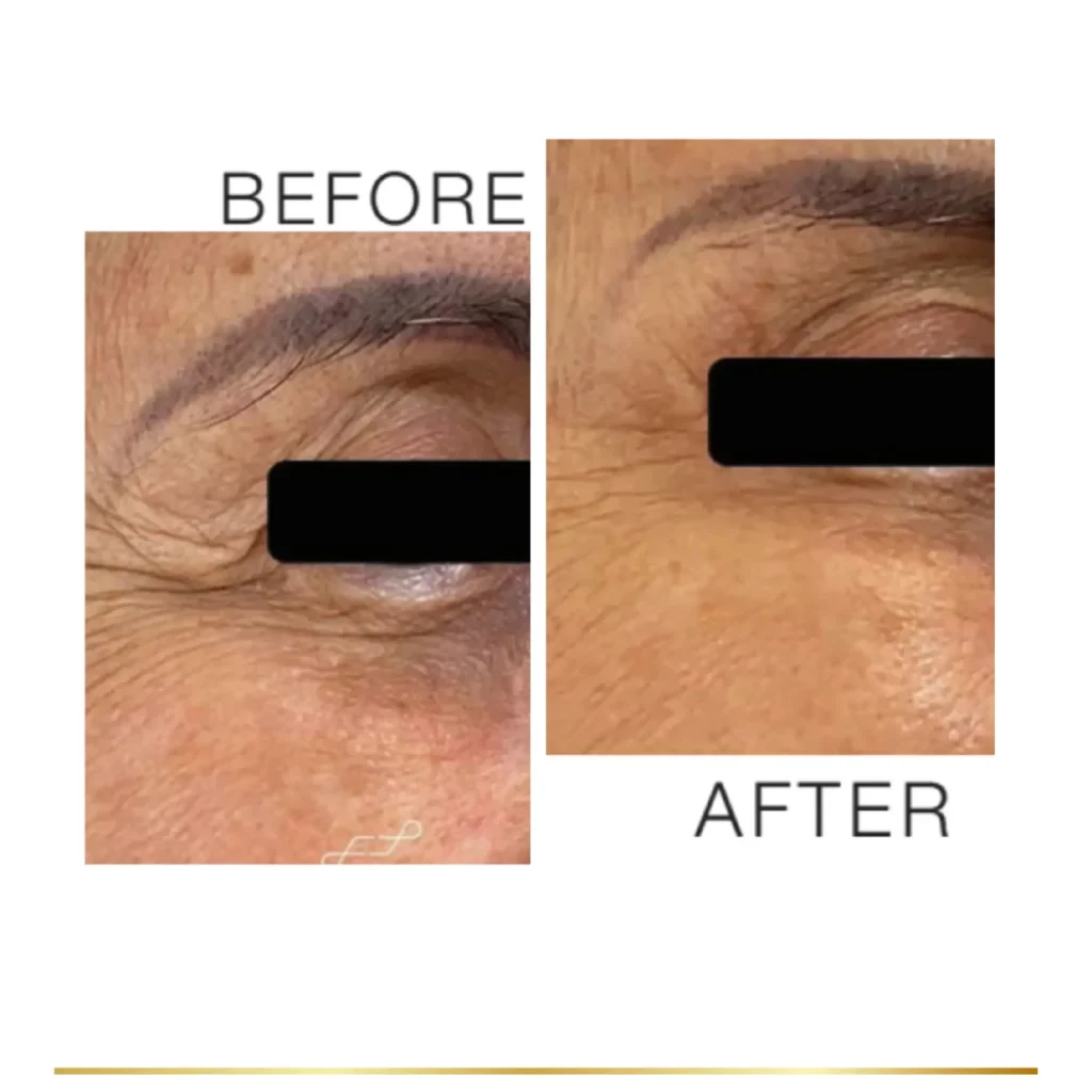 Before and after results showing reduced eye wrinkles and smoother skin after mesoneedling